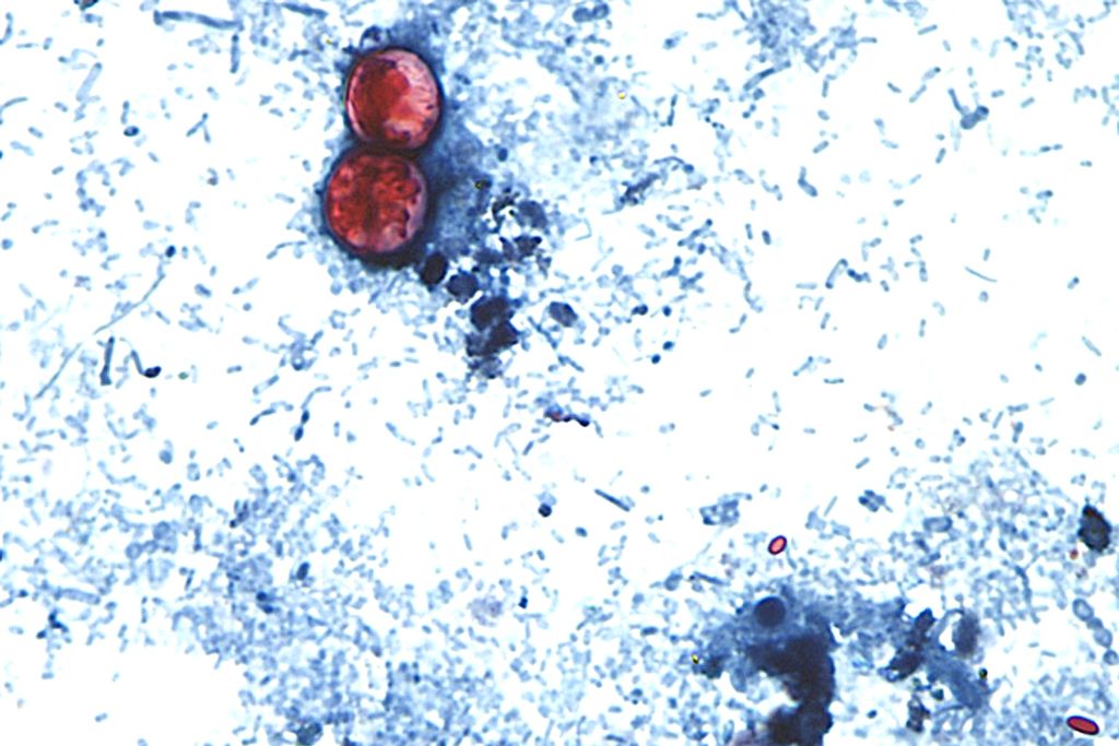 Michigan Reports First 2 U.S. Deaths From Cyclospora